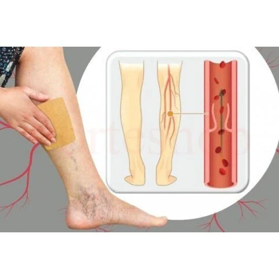 Пластири за разширени вени