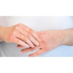 Антибактериален крем за суха и проблемна кожа