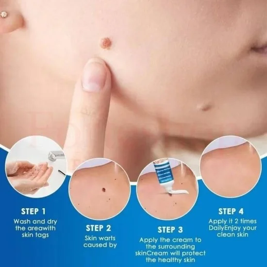 КРЕМ ЗА ПРЕМАХВАНЕ НА БРАДАВИЦИ